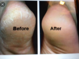 Callus Removal before and after